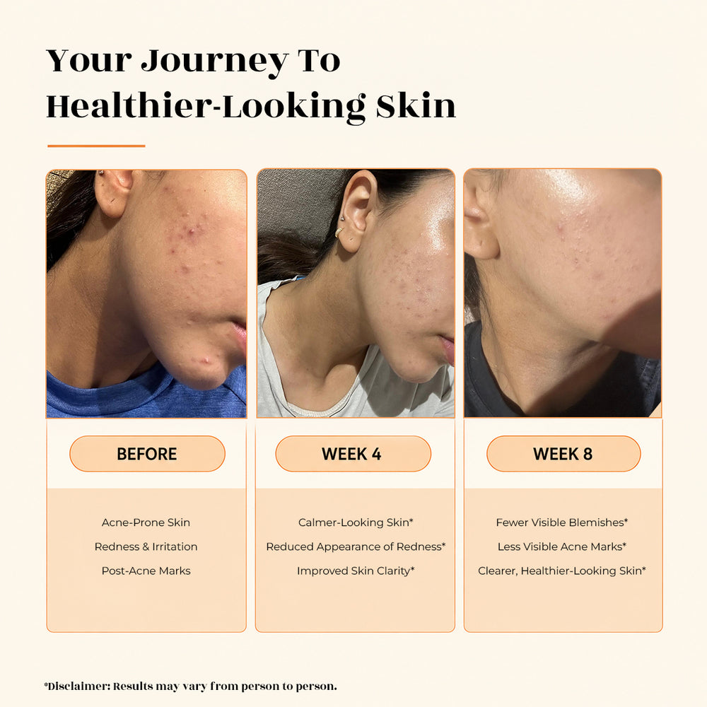 Anti Acne Fizz Tablet